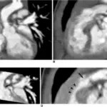 Congenital Heart Disease