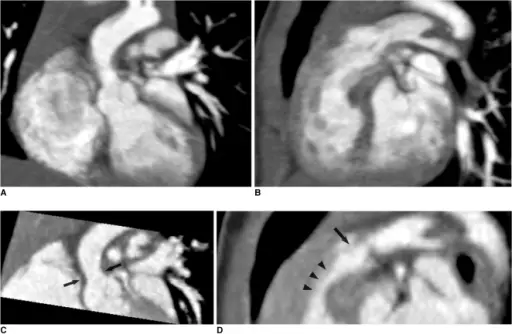 Congenital Heart Disease