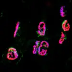 Congenital Myasthenic Syndrome