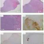 Congenital Nevus