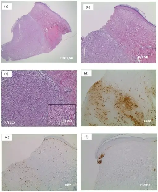 Congenital Nevus