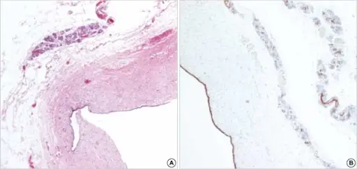 Congenital Pancreatic Cysts.