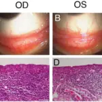 Conjunctival Neoplasms