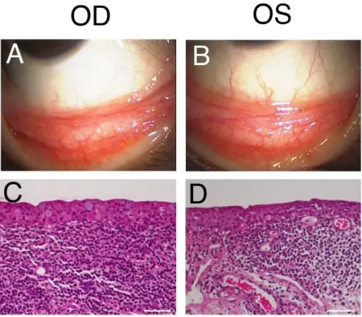 Conjunctival Neoplasms