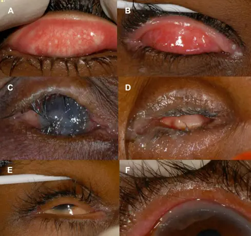 Conjunctival Scarring