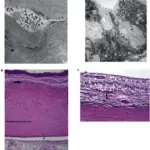 Corneal Degenerations