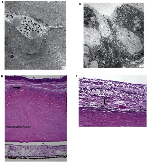 Corneal Degenerations