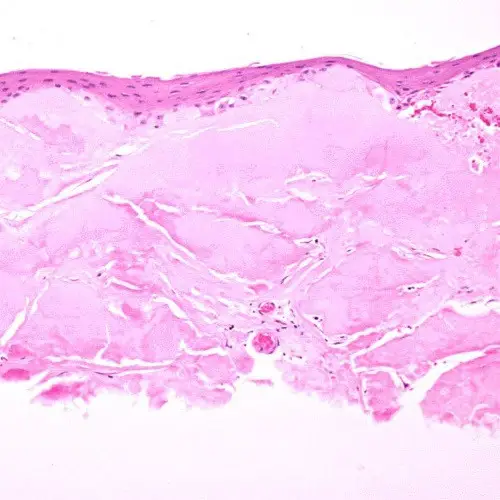 Corneal Dystrophies