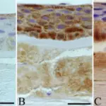 Stromal Dystrophies