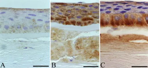 Stromal Dystrophies