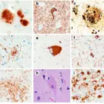 Corticobasal Degeneration