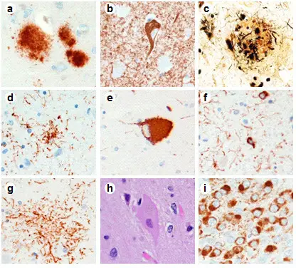 Corticobasal Degeneration