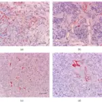 Corticotroph Adenomas