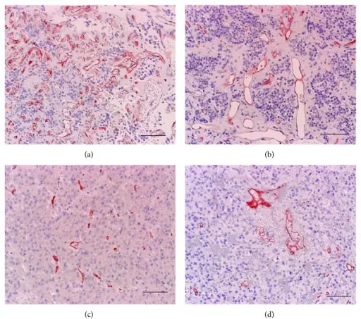 Corticotroph Adenomas