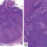 Cowden Syndrome