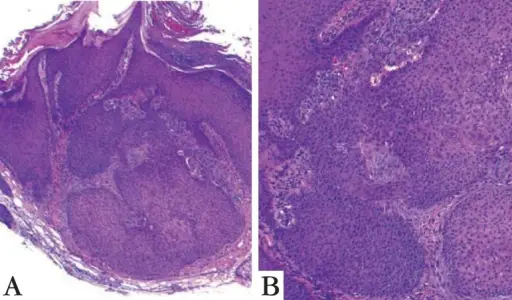 Cowden Syndrome