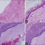 Craniopharyngiomas