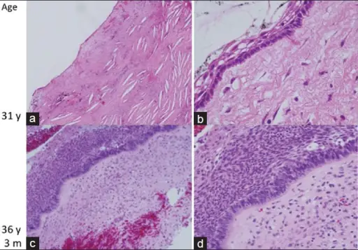 Craniopharyngiomas