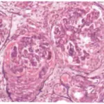 Crescentic Glomerulonephritis