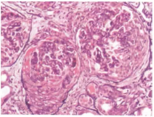 Crescentic Glomerulonephritis