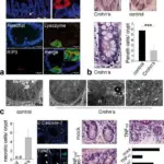 Crohn Disease