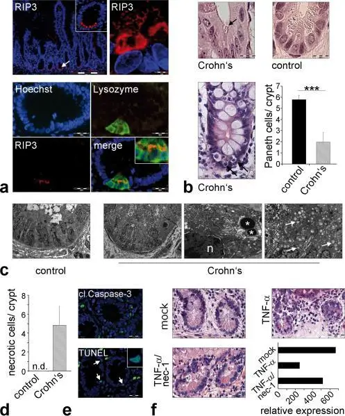 Crohn Disease