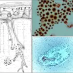 Cryptococcosis Fungal Infection