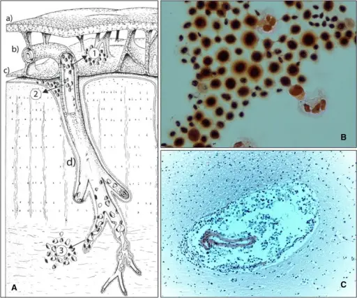 Cryptococcosis Fungal Infection