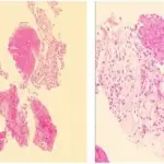 Cryptogenic Organizing Pneumonia