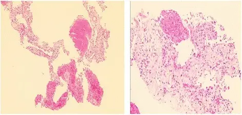 Cryptogenic Organizing Pneumonia