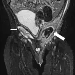 Cryptorchidism