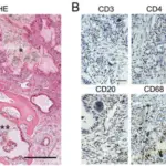 Crystal Induced Arthritis