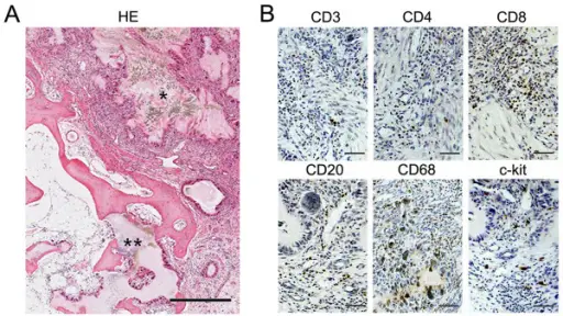 Crystal Induced Arthritis