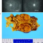 Cushing’s Syndrome