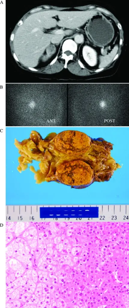 Cushing’s Syndrome