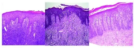 Cutaneous T-Cell Lymphoma aka Mycosis Fungoides