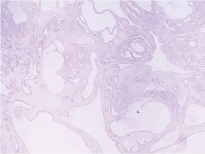 Cystadenofibroma of the Ovary