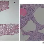 Cystic Disease of the Renal Medulla