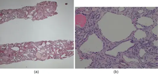 Cystic Disease of the Renal Medulla