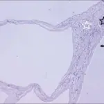 Cystic Diseases of the Kidney