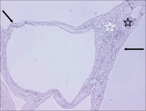 Cystic Diseases of the Kidney