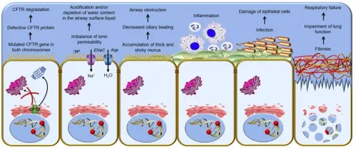 Cystic Fibrosis