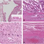 Cystic Neoplasms of the Pancreas