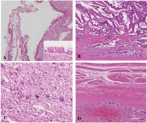 Cystic Neoplasms of the Pancreas