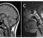 DIFFUSE INTRINSIC PONTINE GLIOMA