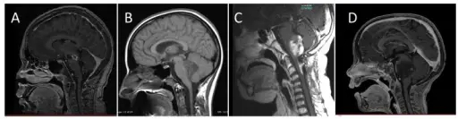 DIFFUSE INTRINSIC PONTINE GLIOMA