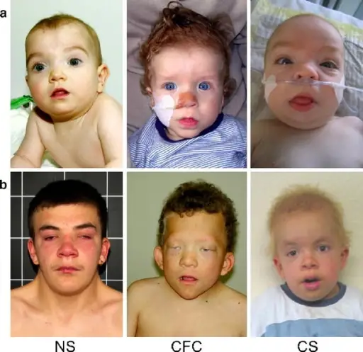 DISEASES OF YOUNG CHILDREN