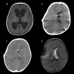 Dandy-Walker Malformation