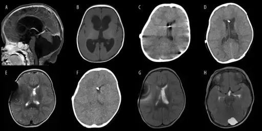 Dandy-Walker Malformation