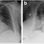 Delayed Hemolytic Transfusion Reaction